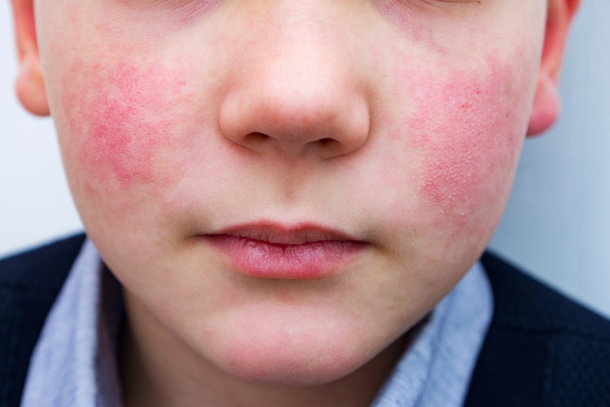 Eritema infeccioso o que é e por que as bochechas ficam rosadas